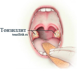 Хронический тонзиллит после ангины