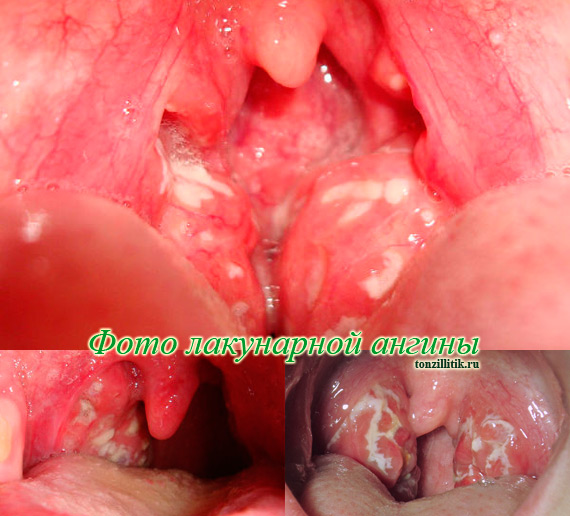 Лакунарная ангина - фото горла